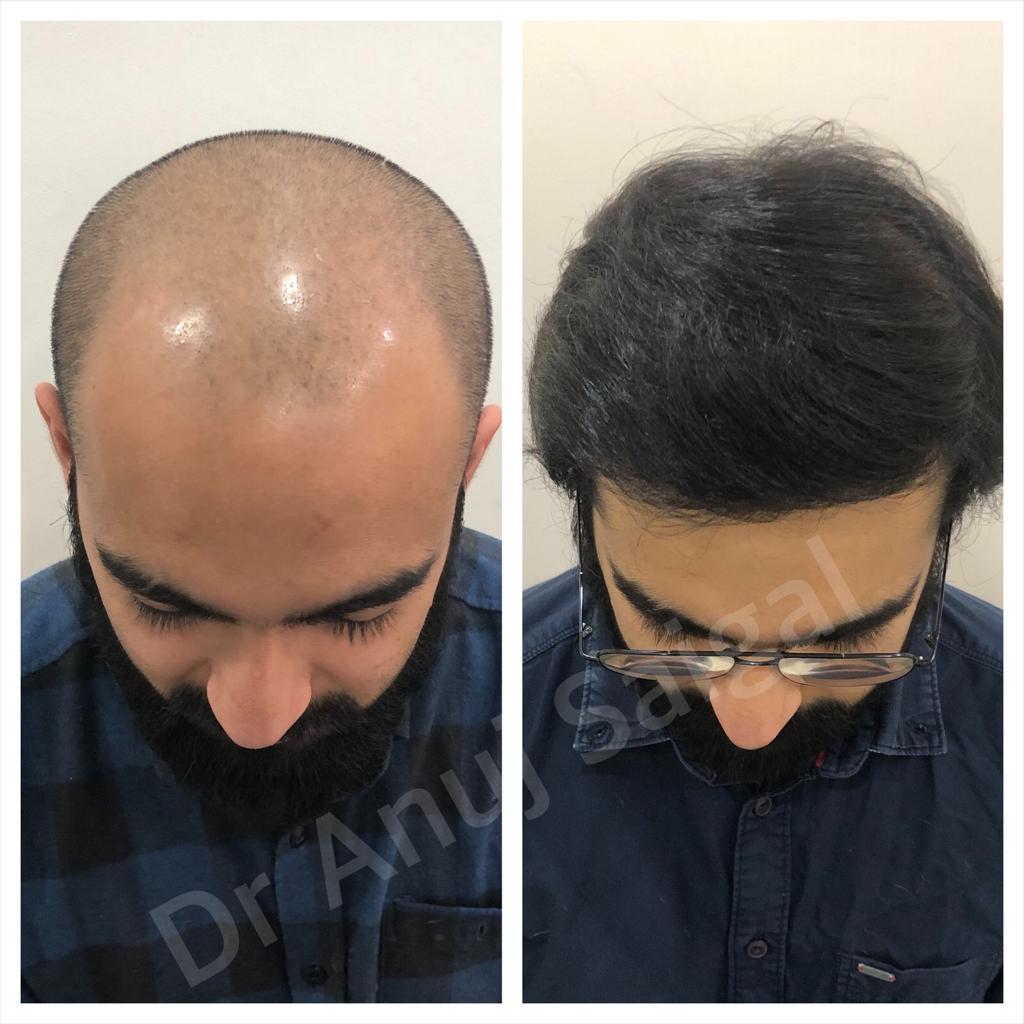 Best hair transplant doctor in delhi